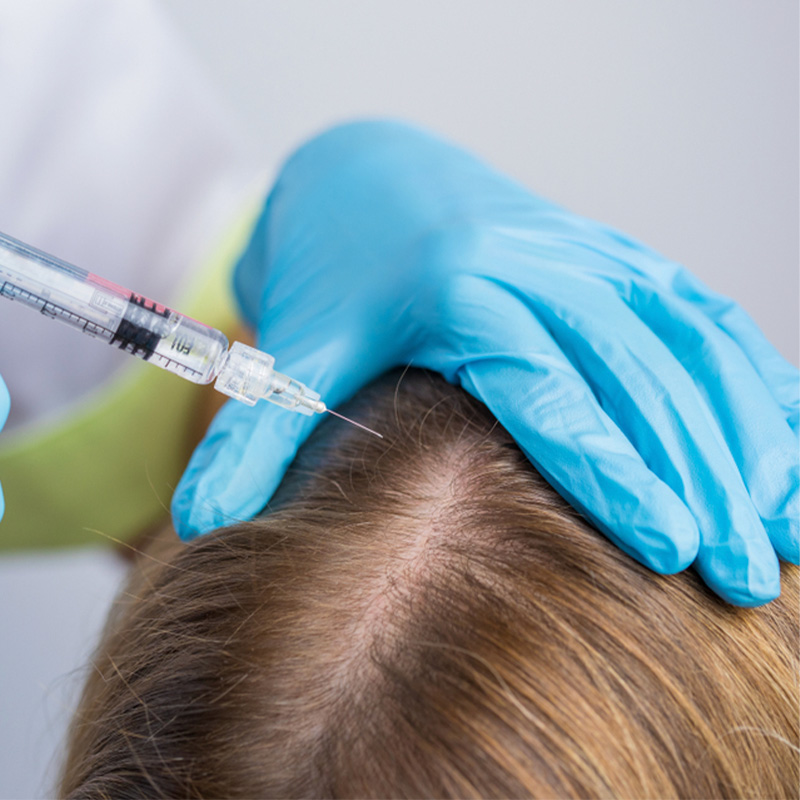 مزوتراپی مو