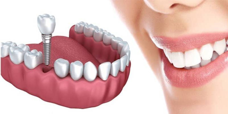 راهنمای کامل کاشت دندان یک روزه در تهران راهنمای کامل کاشت دندان یک روزه در تهران