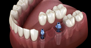 طول عمر ایمپلنت های سوئیسی چقدر است؟